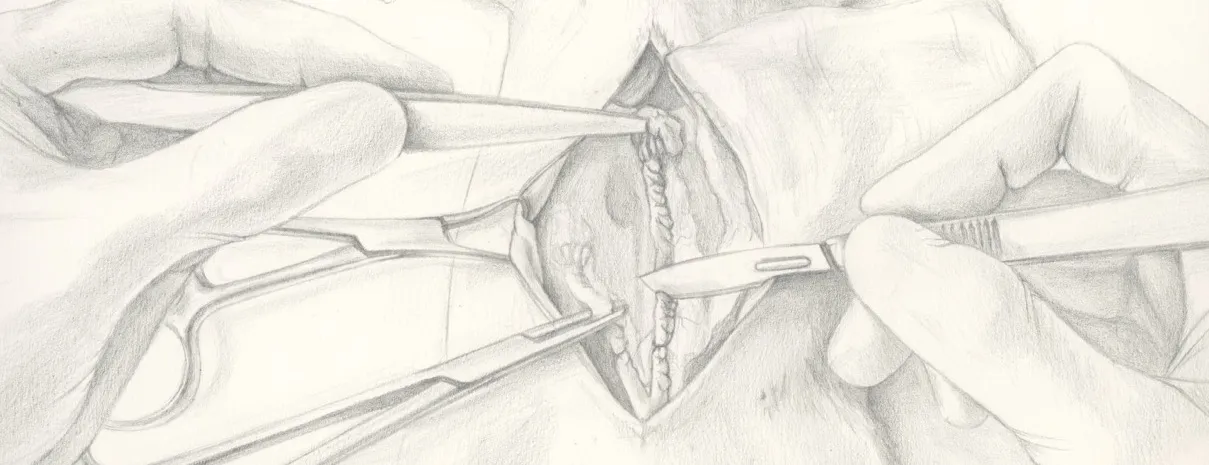 Graphite sketch of gloved hands holding a hemostat and scalpel over an incision