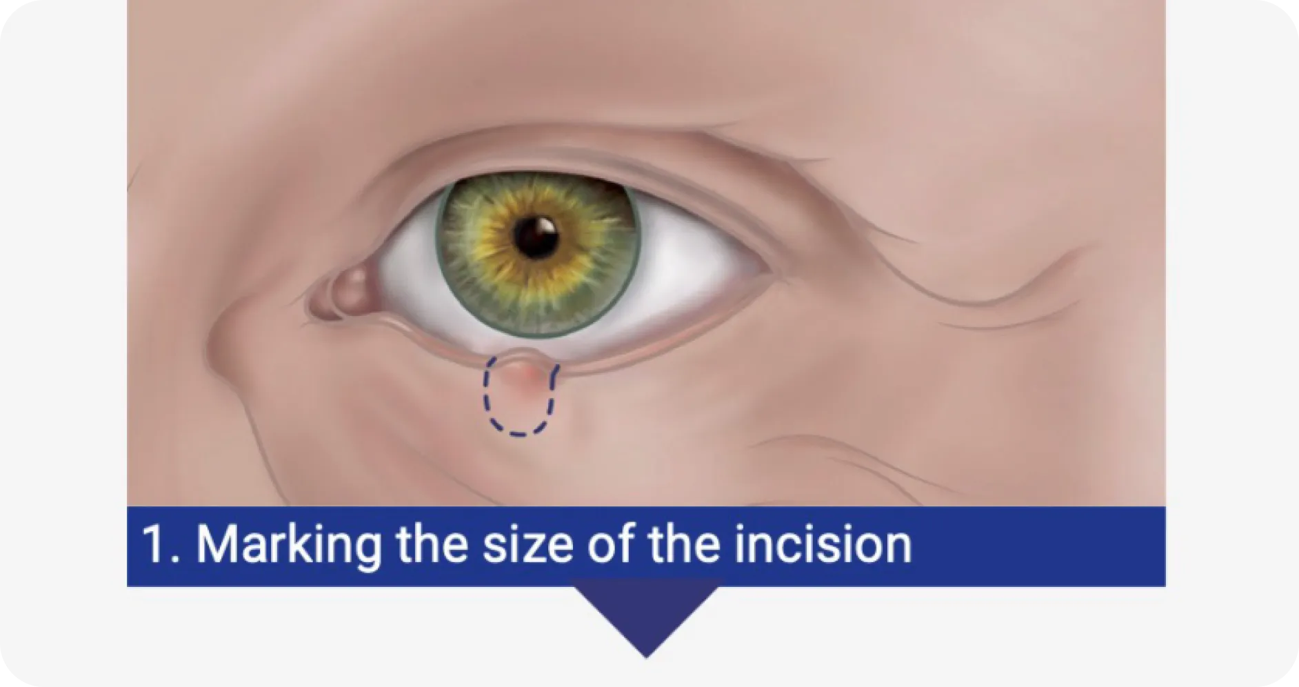 Close-up of an eye with the incision size marked, step one of a procedure