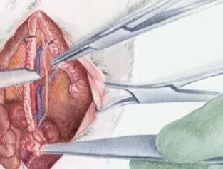 Detail of the open abdominal cavity between the retractor and scalpel, before digital touch-ups